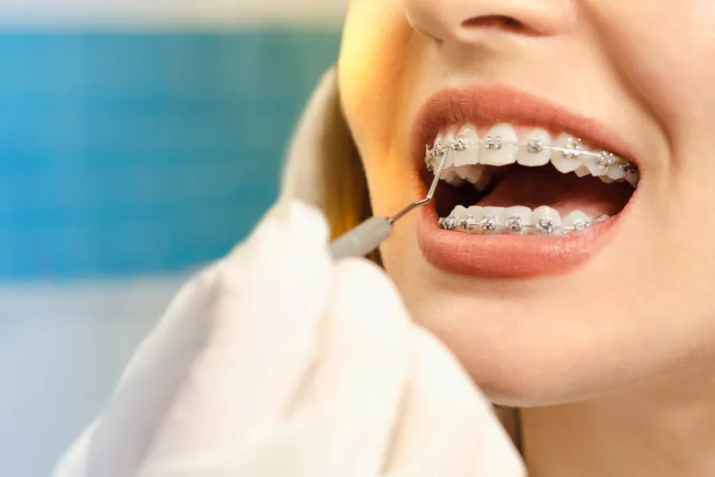 BRACES TREATMENT