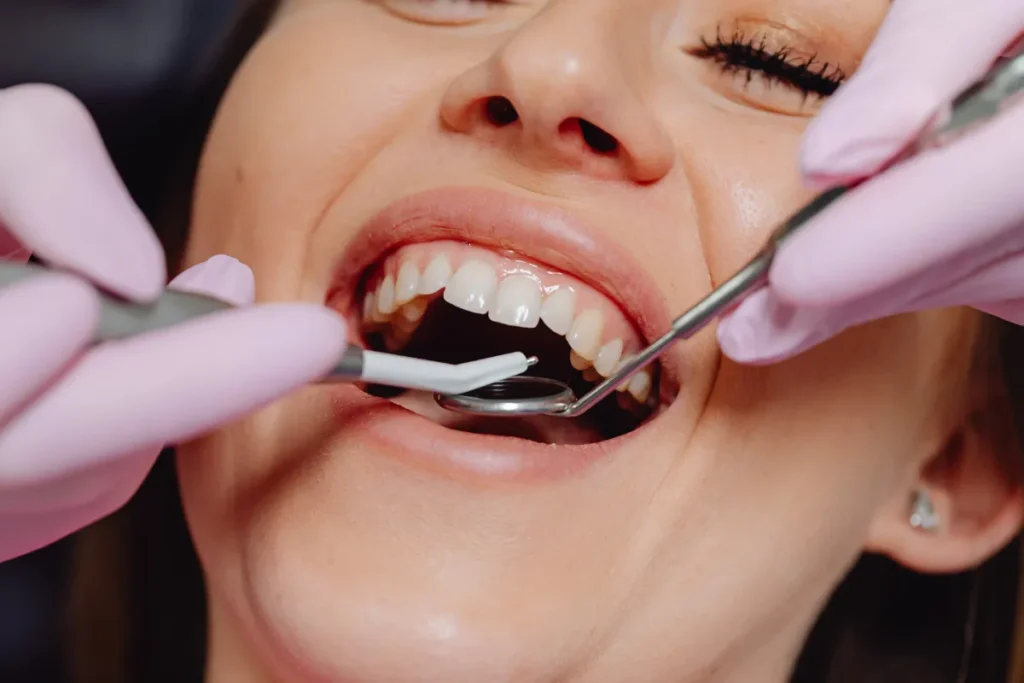 TOOTH FILLING